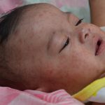 Paparan Campak Di Temukan Di Tempat Umum Carolina Selatan