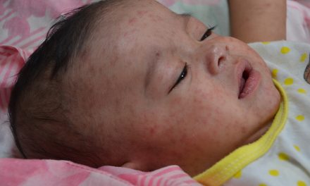Paparan Campak Di Temukan Di Tempat Umum Carolina Selatan