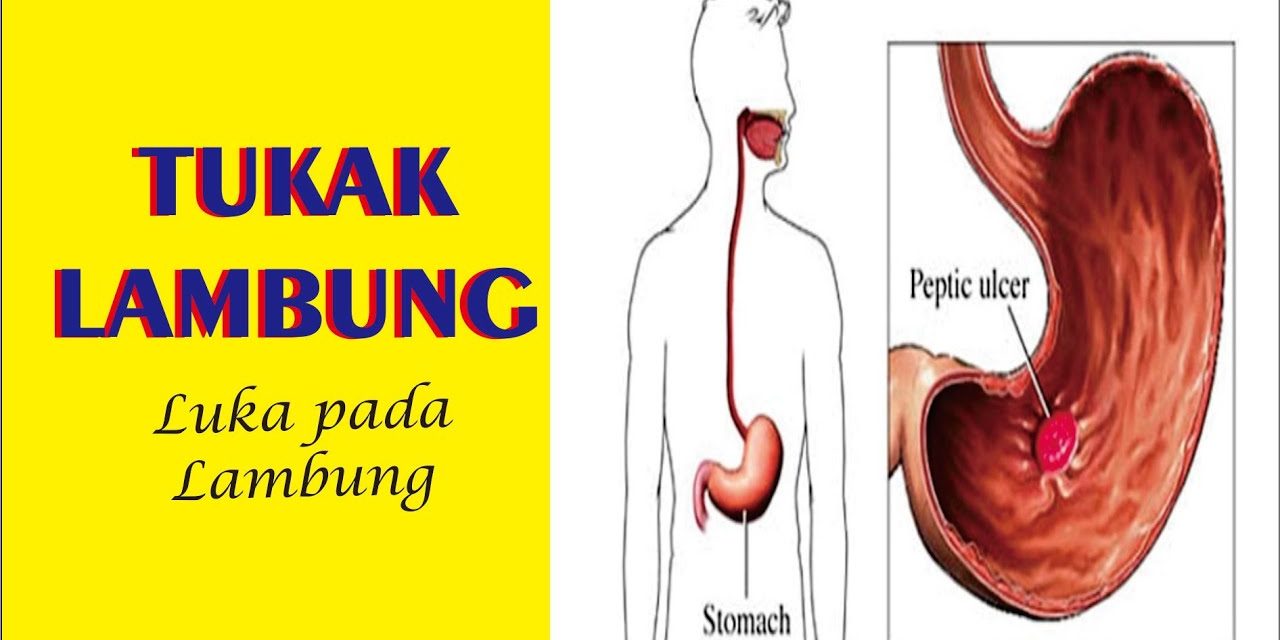 Gejala Tukak Lambung Yang Sering Disalahartikan Sebagai Maag