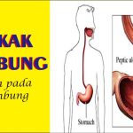 Gejala Tukak Lambung Yang Sering Disalahartikan Sebagai Maag