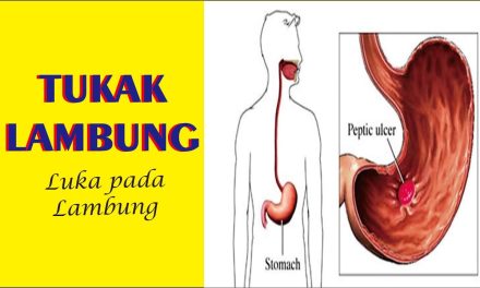 Gejala Tukak Lambung Yang Sering Disalahartikan Sebagai Maag