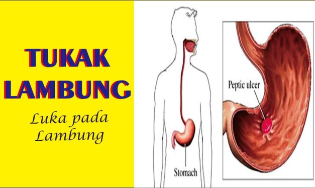 Gejala Tukak Lambung Yang Sering Disalahartikan Sebagai Maag