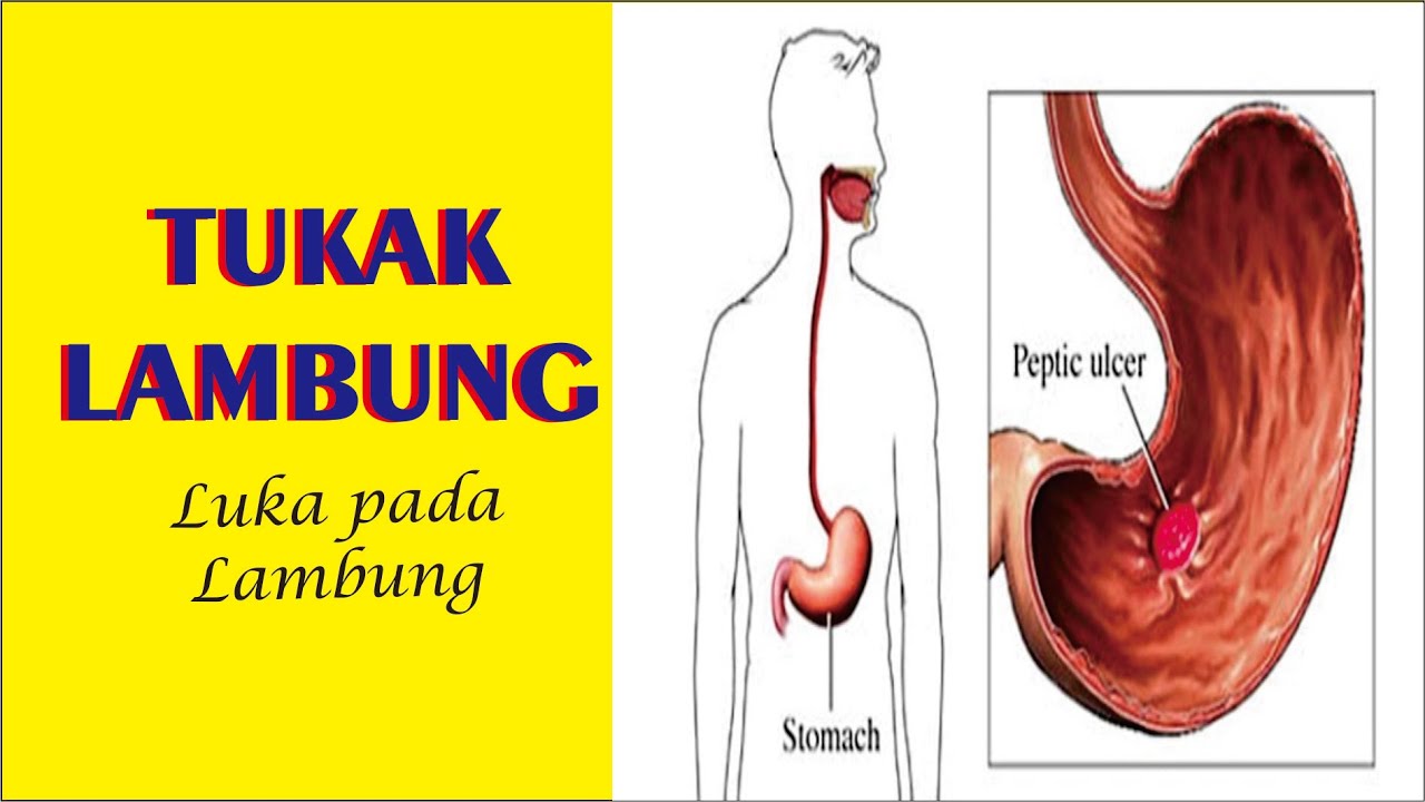Gejala Tukak Lambung